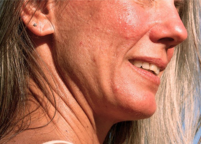 alternative melanoma skin cancer treatment in mexico